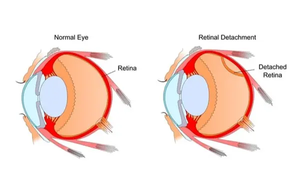 Retinal Detachment